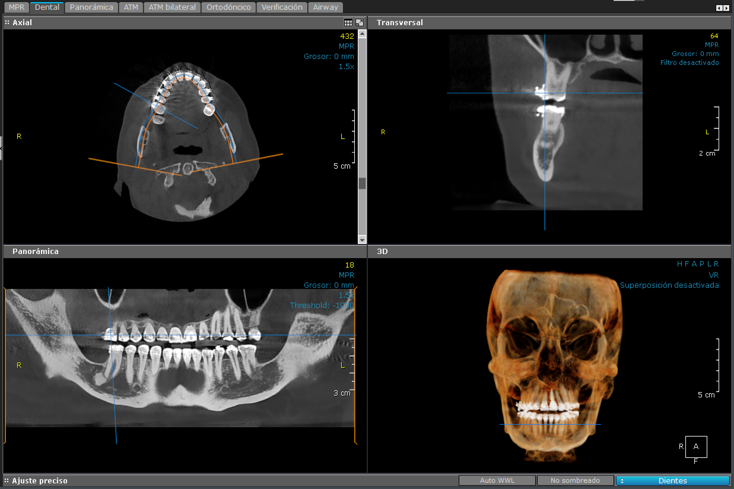 3D - Cara Completa