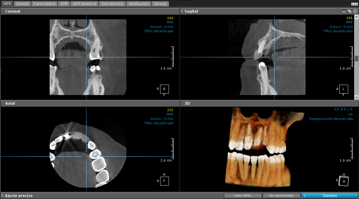 3D - EndoScan HD