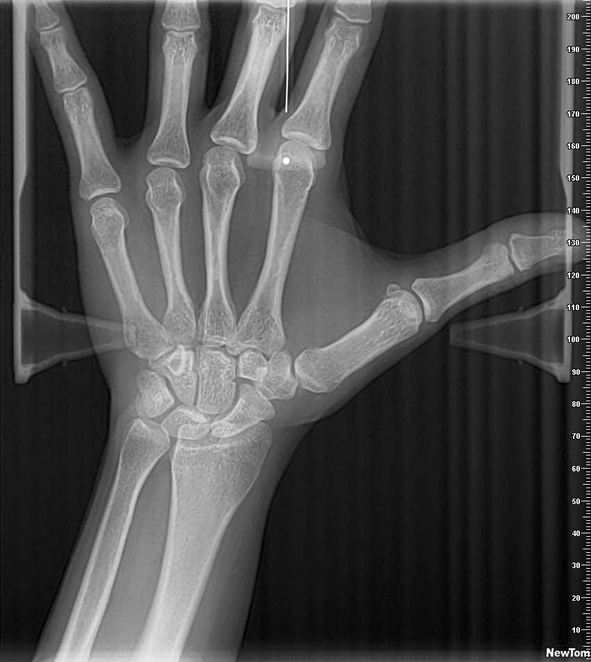 Tele - Carpal